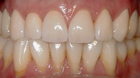 After Porcelain Crowns
