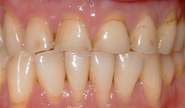 Before Porcelain Crowns